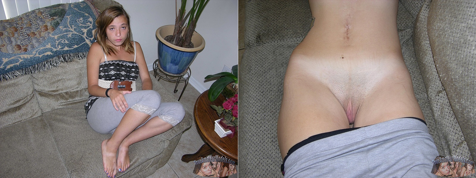 scars nude Scars not from boob jobs or C-sections | FreeOnes Forum - The Free Sex  Community
